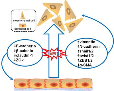 Role of LncRNAs in the Epithelial-Mesenchymal Transition in Hepatocellular Carcinoma